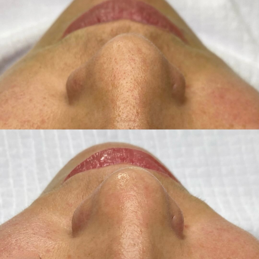 Resultado limpeza de pele 3